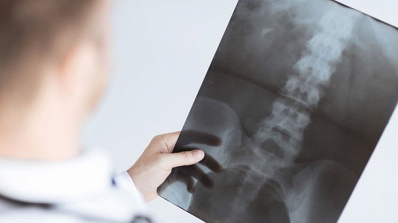Doctor looking at spinal x-ray