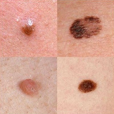Examples of skin blemishes, one of which is melanoma