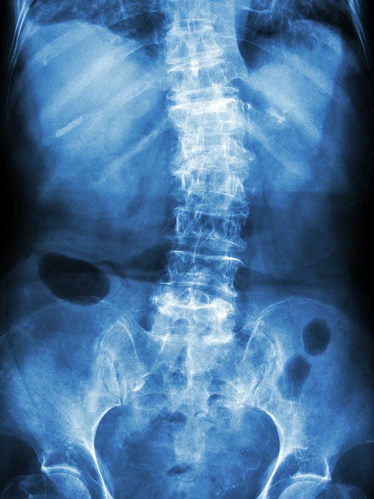 Film x-ray lumbar - sacrum spine show crooked spine caused by Spondylosis and Scoliosis