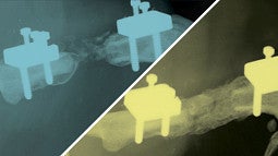 X-rays of damged and healed bones