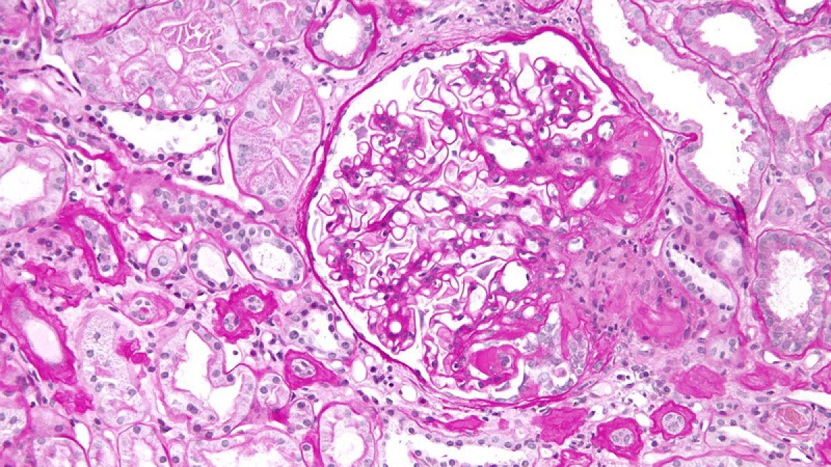 Image shows a micrograph of a kidney affected by focal segmental glomerulosclerosis